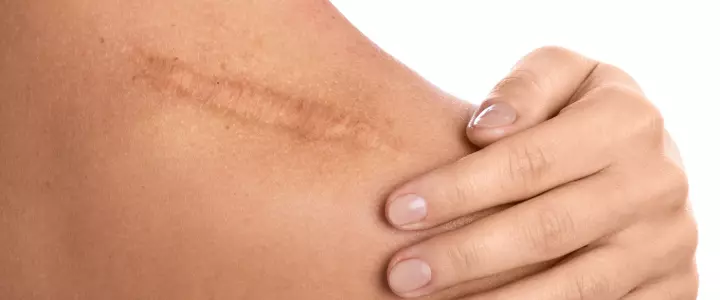 Welke behandeling werkt het beste tegen littekens?